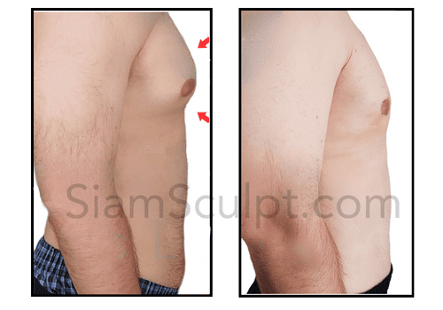 Gynecomastia