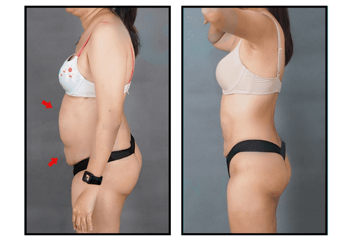 SiamSculpt Mommy Makeover Results of before and after surgery