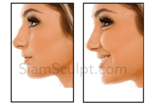 SiamSculpt Nose Job Results Bangkok surgery