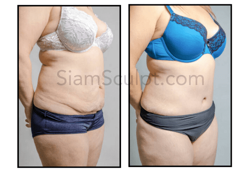 SiamSculpt Tummy Tuck Results After Surgery Bangkok