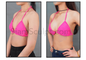 SiamSculpt breast augmentation before and after results Bangkok surgery