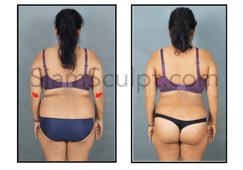 Full Body Liposuction