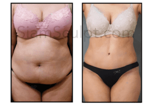 Amazing Tummy Tuck done in Bangkok Thailand 2023 from SiamSculpt