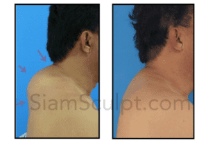 Before and After: Dramatic Results with Buffalo Hump Removal in Bangkok